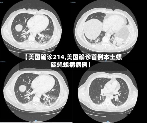 【美国确诊214,美国确诊首例本土螺旋蝇蛆病病例】