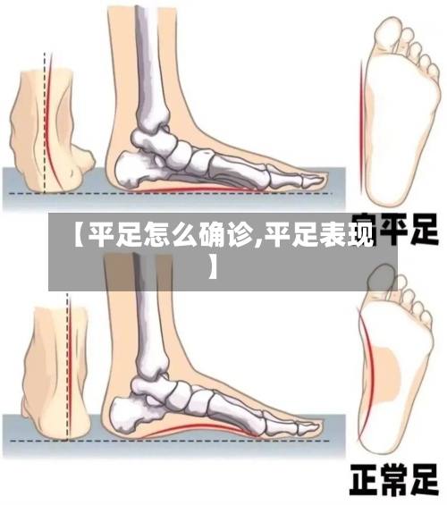 【平足怎么确诊,平足表现】