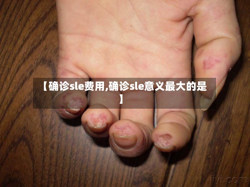 【确诊sle费用,确诊sle意义最大的是】