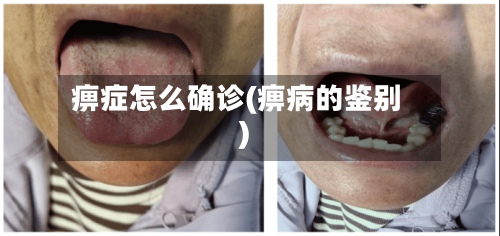 痹症怎么确诊(痹病的鉴别)-第2张图片
